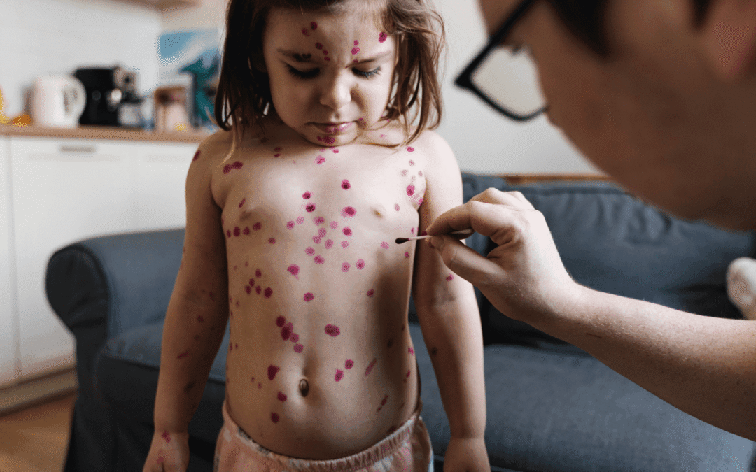 Measles Through Time: From Past to Present, Exploring Causes, Symptoms, Treatment, and the COVID-19 Impact