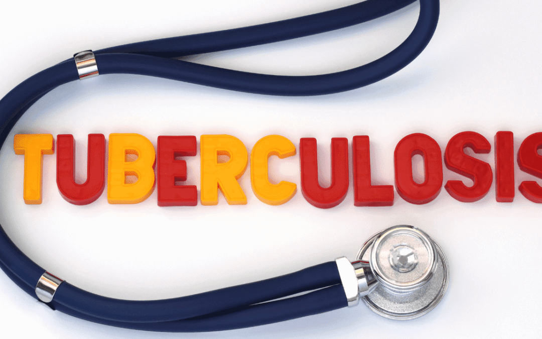 Revolutionizing TB Diagnosis: AI&rsquo;s Breakthrough in Chest X-ray Detection